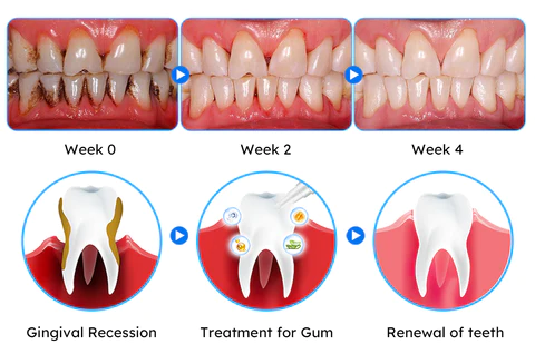 Ijeli ye-Furzero™ Oral Gum Treatment