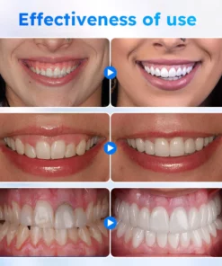 Furzero™ Gel de traitement des gencives buccales