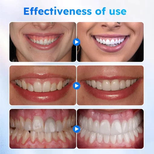 Furzero™ Gel de traitement des gencives buccales