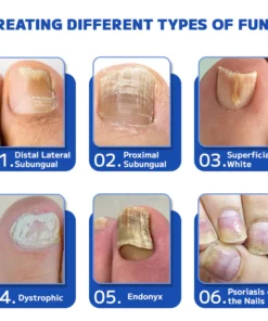 Furzero™ Fungal Nail Treatment Laser Device