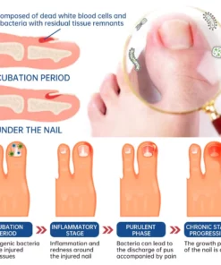 Furzero™ Herbal Formula Fungal nail Paronychia treatment Gel