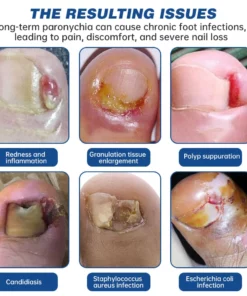 Furzero™ Herbal Formula Fungal nail Paronychia treatment Gel