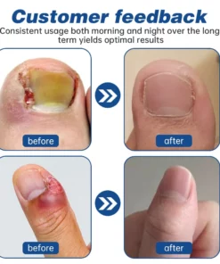 Furzero™ Herbal Formula Fungal nail Paronychia treatment Gel