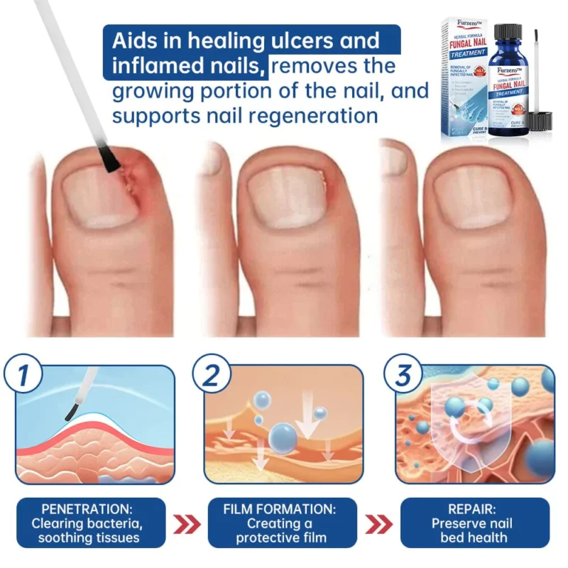 Furzero™ Herbal Formula Fungal nail Paronychia treatment Gel