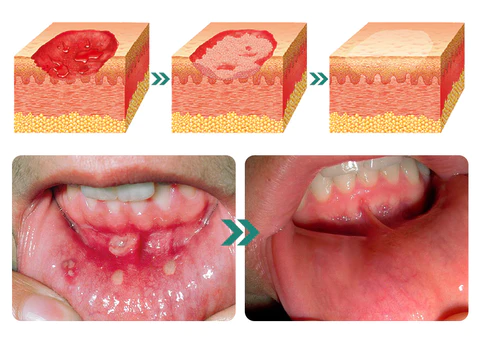 Furzero™ Herbal Mouth Spray