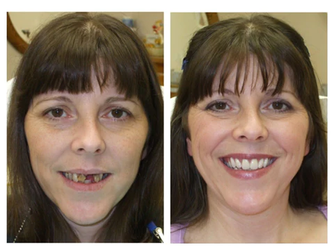 Furzero™ Kräuterhelles Mundreparatur-Schaum