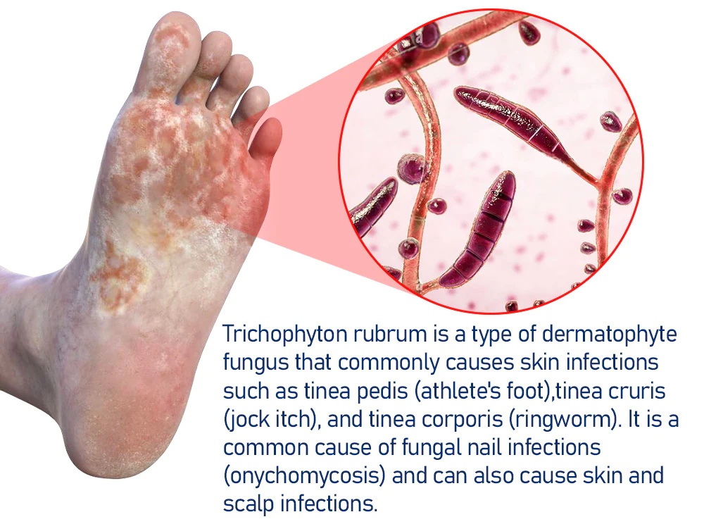 Furzero™ Medizinisches Nagelpilz-Fußspray