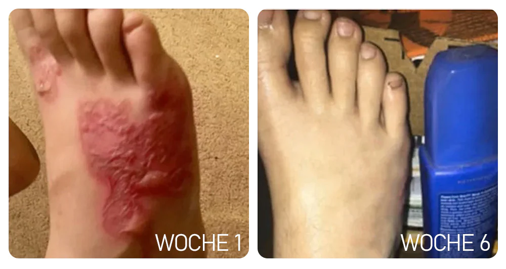 Furzero™ Medizinisches Nagelpilz-Fußspray