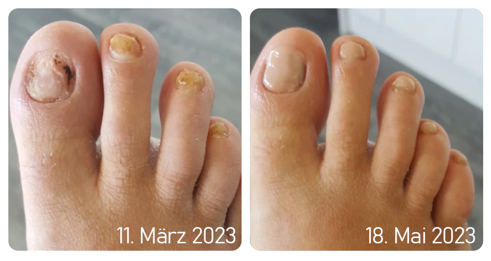 Furzero™ Medizinisches Nagelpilz-Fußspray
