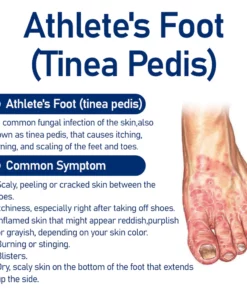 Furzero™ Medizinisches Nagelpilz-Fußspray