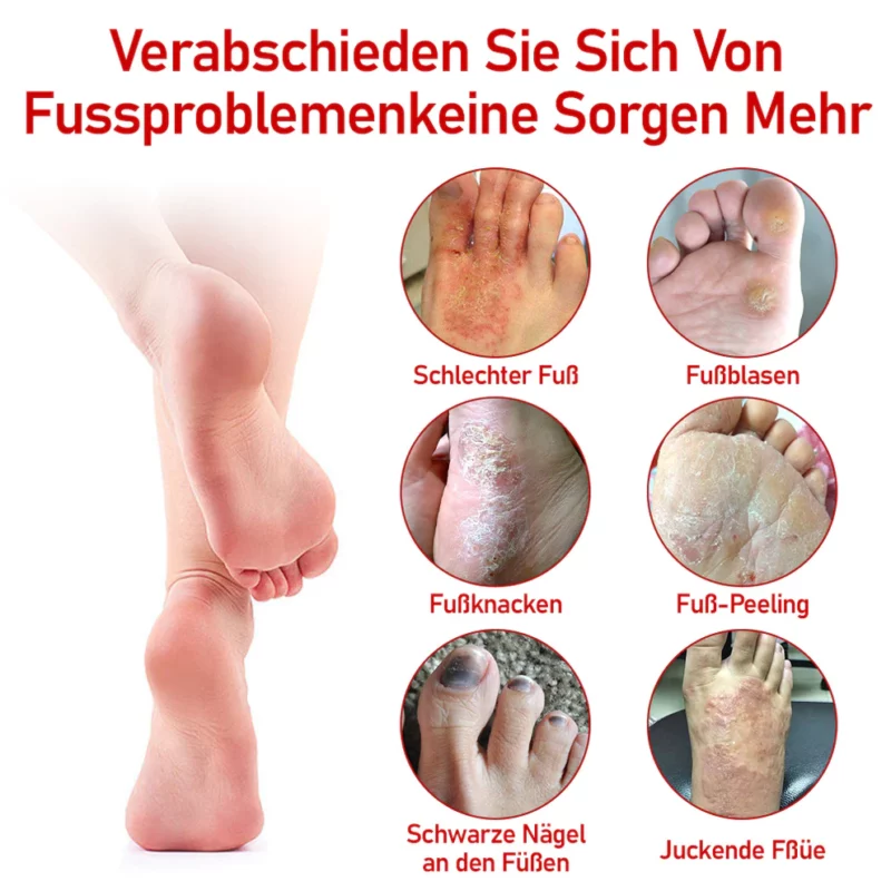 Furzero™ Medizinisches Nagelpilz-Fußspray