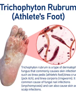 Furzero™ Medizinisches Nagelpilz-Fußspray