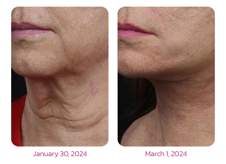 Furzero™ NECKUP Collagen Potentiating Neck Cream