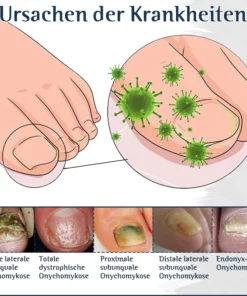Furzero™ Nachtpflaster zur Behandlung von Nagelpilz