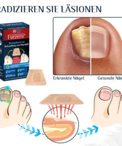 Furzero™ Nachtpflaster zur Behandlung von Nagelpilz
