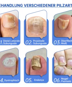 Furzero™ PureNail Pilz-Lasertherapiegerät