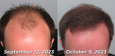 GFOUK™ EvolveGRO Far Infrared Hair Therapy Cap