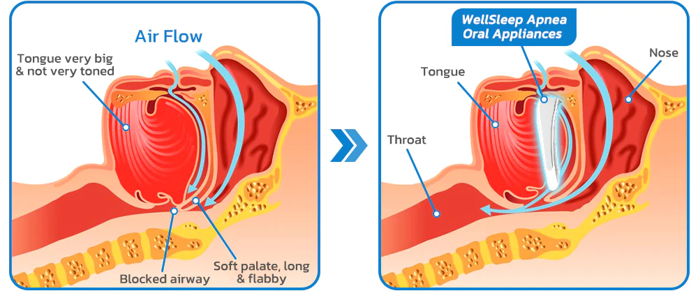 GFOUK™ WellSleep Apnea Oral Appliances