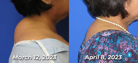 GFOUK™ HumpEase Bee Venom Smoothing Plaster