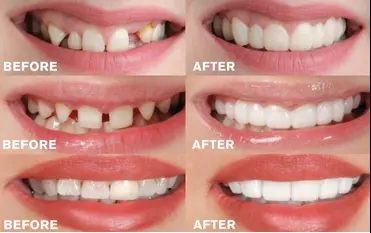 HONXI™ Justerbar protes med snäppfäste