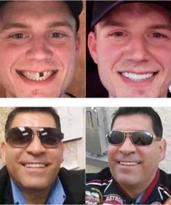 HONXI™ Adjustable snap-on prosthesis