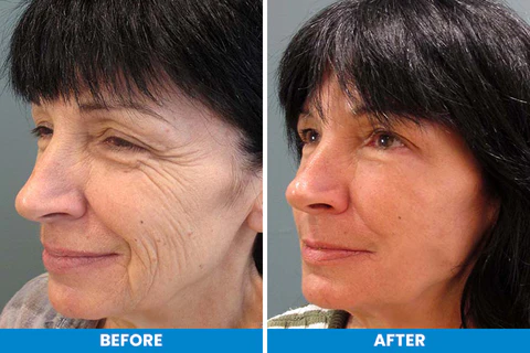 KISSHI™ Botox Facial Essence