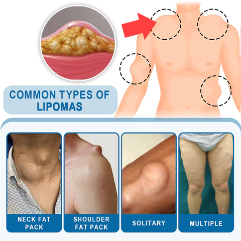 KISSHI™ Lipoma Removal Cream
