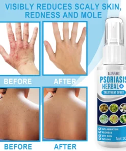 KISSHI™ Psoriasis Herbal Treatment Spray