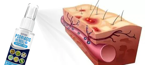 KISSHI™ Psoriasis Herbal Treatment Spray