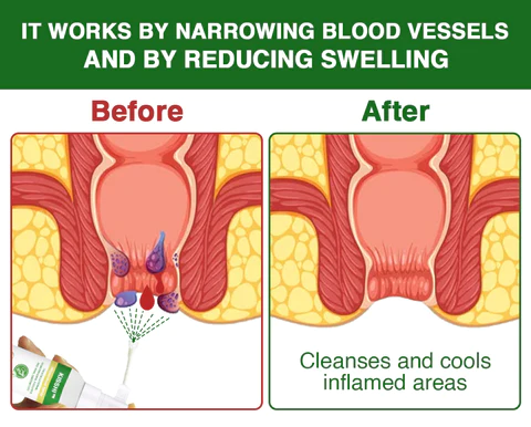 Kisshi™ Hemorrhoid Spray