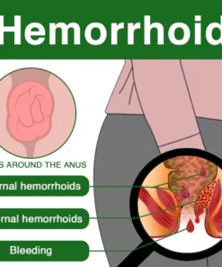 Kisshi™ Hemorrhoid Spray