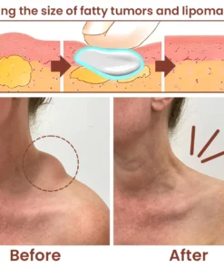 LumpGone™ Lipoma Removal Herbal Cream