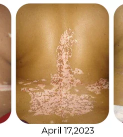MelFix™ Vitiligo Therapy Cream