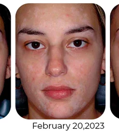 MelFix™ Vitiligo Therapy Cream