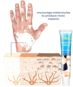 MelFix™ Vitiligo Therapy Cream