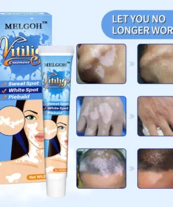 Melgoh™ Clinically Proven Vitiligo Ointment