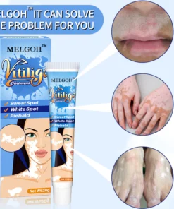 Melgoh™ Clinically Proven Vitiligo Ointment