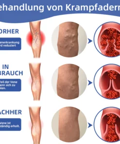 Ourlyard ™ Medizinisches VenenEase Therapie spray