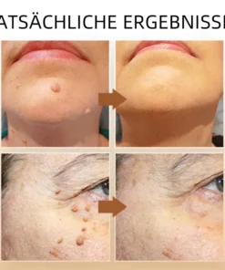 Ourlyard™ Biene Venom Wart und Tags Entfernung Behandlung Spray