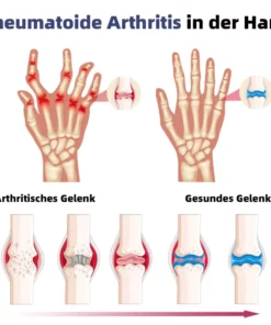 Ourlyard™ Neuseeland Bienengift Gelenk- und Knochen-Therapie Fortgeschrittene Creme