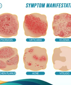 Ourlyard™ Psoriasis- und Ekzem-Naturheilmittel-Spray