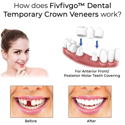 Oveallgo™ Dental Crown Veneers