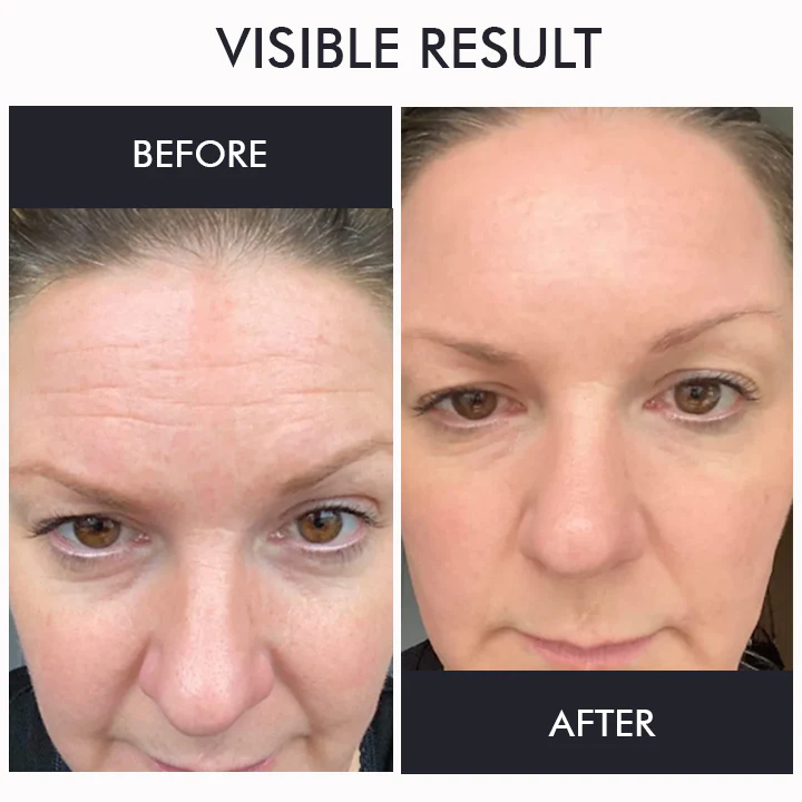 Oveallgo™ Korea Gold Seal Lifting Cream+ 2-in-1 Red Light / EMS teraapiaseadmete komplekt