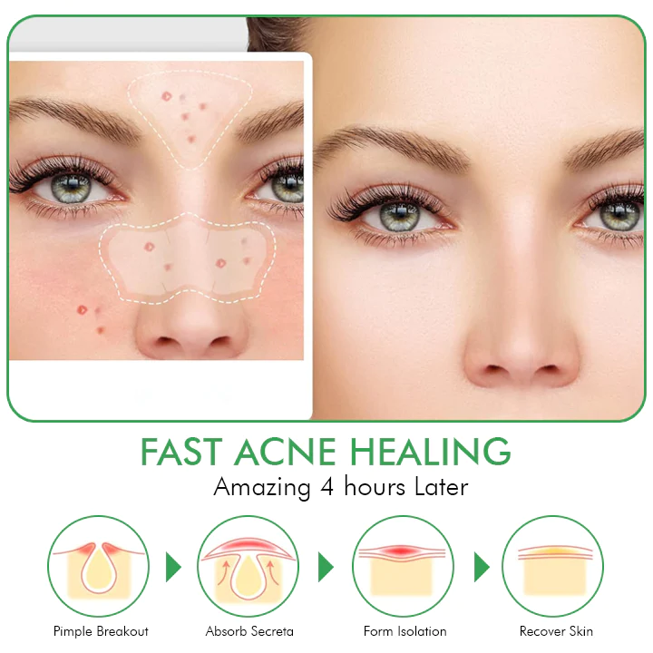 Oveallgo™ Overnight Hydrocolloid Acne Clear Patches