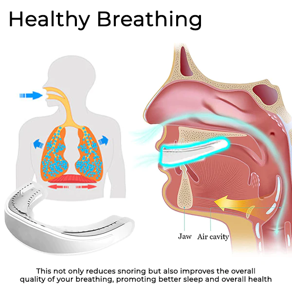 Oveallgo™ WellSleep Apnea Oral Appliances