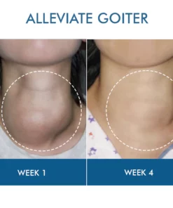 Oveallgo™ Goiterless Neck Skin Firming Serum