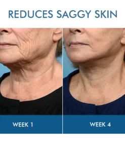 Oveallgo™ Straffendes Serum für die Halshaut ohne Kropf