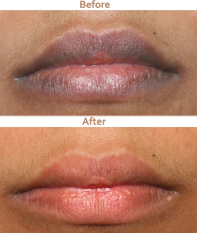 Чист природен балзам за усни за намалување на меланин