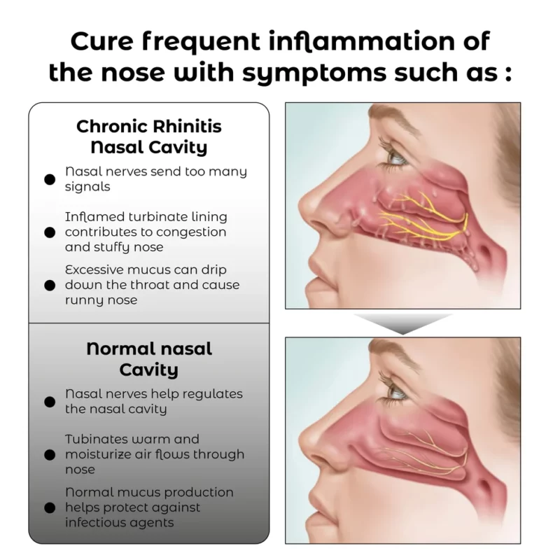 I-RICPIND EMS RespiRestore Nasal Therapy Device