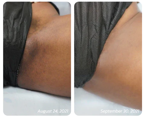Seurico ™ Lactic Acid Melasma Cream